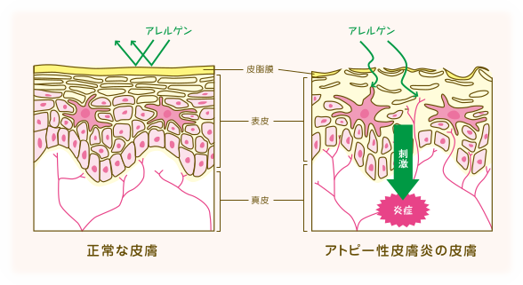 アトピー性皮膚炎の皮膚