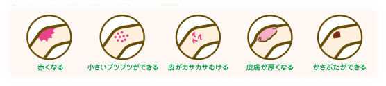 アトピー性皮膚炎症状